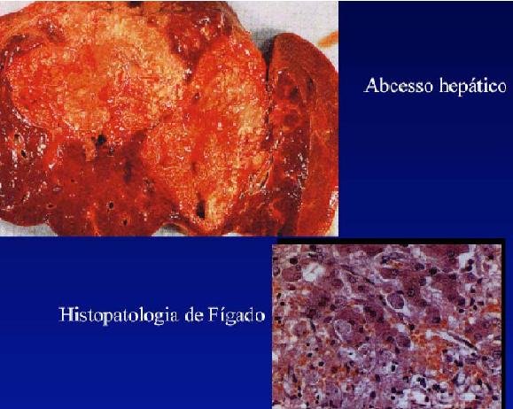 ABSCESSO HEPATICO