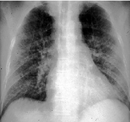 ESTRONGILOIDOSE PULMONAR