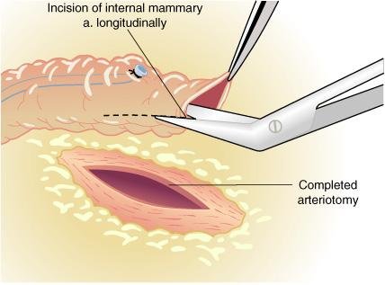 A técnica da anastomose entre a artéria mamaria interna e a artéria descendente anterior esquerda ilustra os princípios gerais usados para a construção de to¬das as anastomoses proximais e distais. O enxerto é aberto longitudinalmente para parear ou exceder o comprimento da arteriotomia coronariana. Esta abertura previne uma angula-ção no local da anastomose da mamaria interna e da aorta com a veia safena. Esta abertura não é necessária no sitio anastomótico distai da veia, porém um ligeiro biselamento da veia distai ajuda a prevenir a angulação da veia safena na anastomose com a artéria coronária.